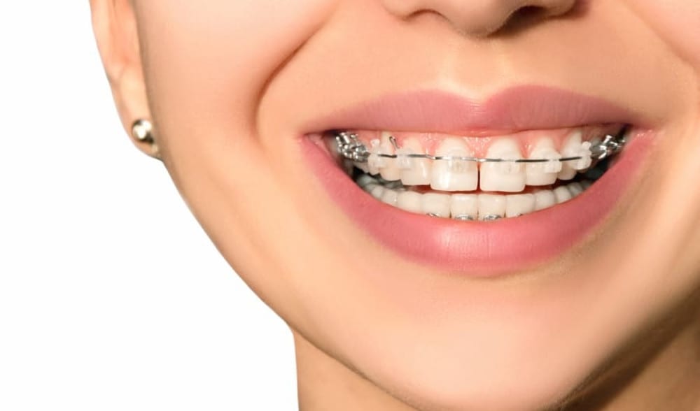 The Benefits of Choosing Dental Implants in Sheffield for Missing Teeth